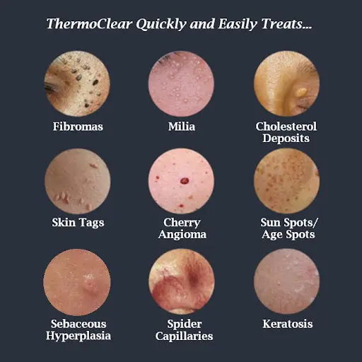 Thermoclear Quickly and easily treats