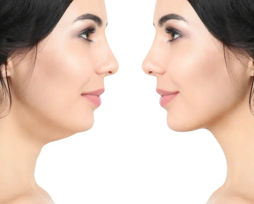 double chin comparison